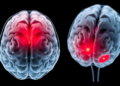 Measuring Swelling Around Treated Brain Tumors May Reveal Why Some Fail Radiation Therapy