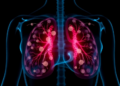 New Prediction Tool Could Spare Breast Cancer Patients Unnecessary Lymph Node Surgery