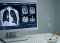 Smoking shows limited direct association with metastatic lung adenocarcinoma radiomics