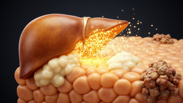 Cell Death Protein MLKL Emerges as Unexpected Driver of Obesity-Linked Liver Cancer