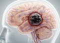 Review links aging brain biology with tumor progression