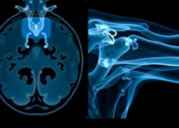 Shoulder MRI Capsule Findings Often Mistaken for Frozen Shoulder, Study Warns
