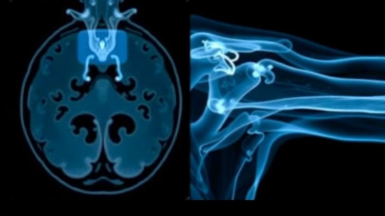 Shoulder MRI Capsule Findings Often Mistaken for Frozen Shoulder, Study Warns