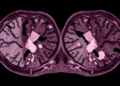 Indirect Trial Comparison Suggests Retifanlimab Edges Out Avelumab in Metastatic Merkel Cell Carcinoma