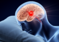 Sleeping Too Little or Too Long Linked to Higher Brain Bleed Risk in Large UK Cohort
