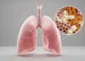 Cryptogenic Organizing Pneumonia Shows Strong Survival but Relapses in Over 20% of Chinese Patients