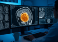 Multi-scale transformer network sharpens brain tumor segmentation on MRI scans
