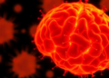Mini-GRID Radiotherapy Curbs Cellular Senescence While Keeping Its Anti-Tumor Punch in Glioma Cells