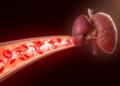 Pacritinib After Ruxolitinib: Five-Case Saudi Series Reports Higher Blood Counts and Smaller Spleens
