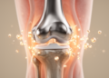 Low-Dose Clindamycin Achieves 82% Two-Year Success Against Prosthetic Joint Infections