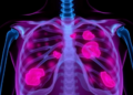 Race and Income Predict Survival in Breast Cancer That Spreads to Bone, Study Finds