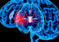 Brain Scans Reveal Hidden Damage When Diabetes Meets Small Vessel Disease