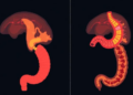 Machine Learning Maps a Year of Gut Symptoms After Esophageal and Gastric Cancer Surgery