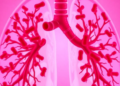 Neutrophil Traps in the Blood Show Strong Promise for Diagnosing Pneumonia and Spotting Mixed Infections