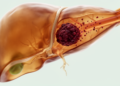 Shrinking the Untreatable: Blood-Vessel Tumor Thrombus Vanishes in Advanced Liver Cancer Case