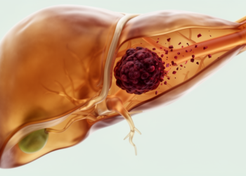 Shrinking the Untreatable: Blood-Vessel Tumor Thrombus Vanishes in Advanced Liver Cancer Case