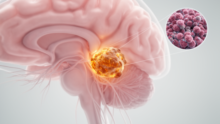 Rare Brain Tumor Puzzle: Fetal-Type Cancer in the Cerebellopontine Angle With No Lung Primary Found
