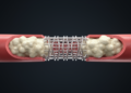 More Aggressive Calcium Clearing May Not Improve Heart Stent Outcomes