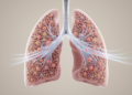 Sixty Years After ARDS Was Named, Scientists Ask Whether Ventilation Can Help Lungs Repair