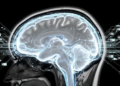 Attention-Guided Distillation Boost Alzheimer's Stage Identification Using MRI Scans