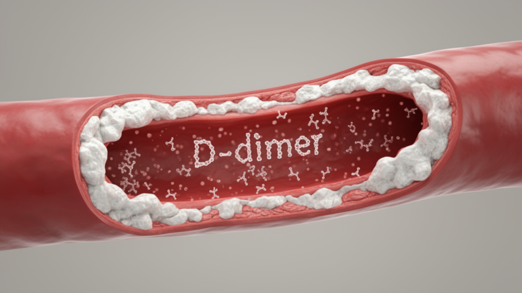 Blood Clot Marker D-dimer Linked to Artery Calcification in Dialysis Patients