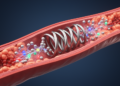 Targeting the Root Causes of Coronary Stent Restenosis: New Mechanism-Guided Approaches