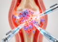 New Review Targets Better Infection Diagnosis in Inflammatory Arthritis Patients