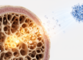 Statins May Slow Bone Loss After Menopause by Rerouting Stem Cell Signals