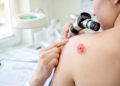 Rare Skin Cancers May Signal Hidden Risks of Second Cancers Later in Life