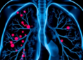 Data-Efficient AI Transformer Hits Near-Perfect Accuracy in Lung Cancer Diagnosis