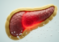 Obesity may more than double odds of organ failure in acute pancreatitis