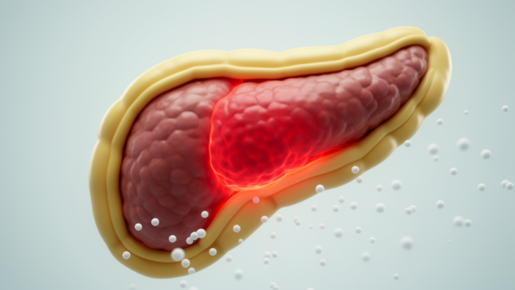 Obesity may more than double odds of organ failure in acute pancreatitis