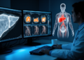 Liver fat on spectral CT links to coronary plaque danger signs in chest pain patients