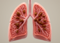 Pancreatic Cancer Hiding in the Lungs: A Case of Mistaken Interstitial Disease