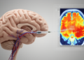 Super-selective Wada test paired with CT perfusion maps language zones before brain surgery