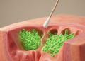 Core Tonsil Tissue Hides Bacteria That Surface Swabs Miss in Chronic Tonsillitis