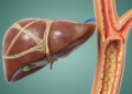 Liver Fibrosis, Not Fatty Liver Alone, Signals Macrovascular Risk in Type 2 Diabetes