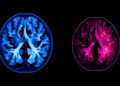 PET Scans and Tumor Immunity: New Study Probes the Hidden Link in Breast Cancer