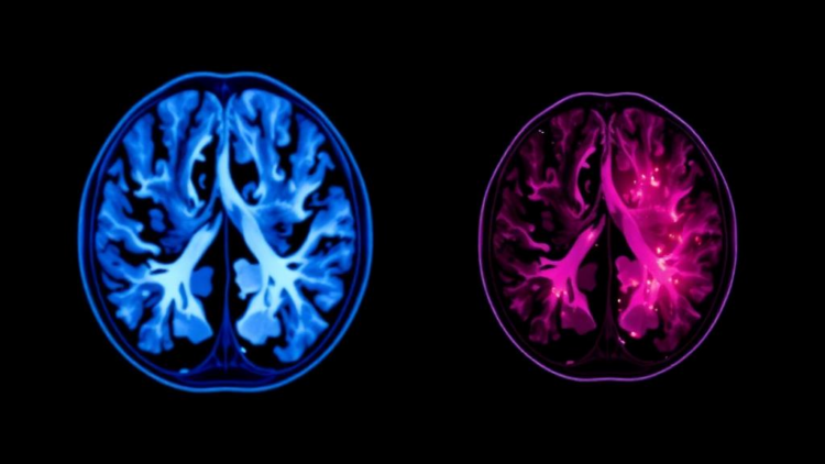 PET Scans and Tumor Immunity: New Study Probes the Hidden Link in Breast Cancer