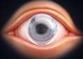 Inside the implantable collamer lens: mapping the safety limits of high-myopia surgery
