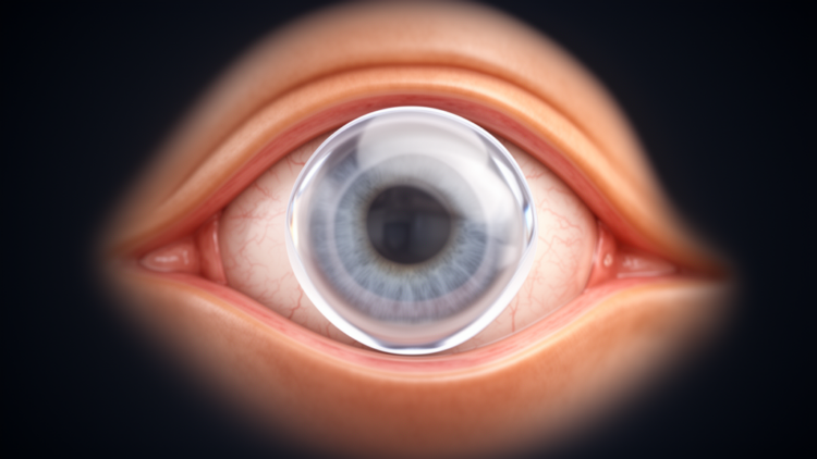 Inside the implantable collamer lens: mapping the safety limits of high-myopia surgery