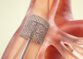Fifteen Years of Subclavian Artery Occlusion Devices Have Not Yet Proven Better Outcomes