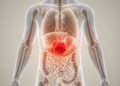 Tumour location shapes survival in rare leiomyosarcoma, study of 11,700 patients finds