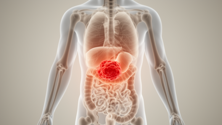 Tumour location shapes survival in rare leiomyosarcoma, study of 11,700 patients finds