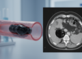 Embolism-cast CT tracking shows Obsidio gel shrinking as radiodensity rises