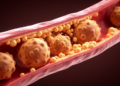 Ancient Chinese Formula Sini Decoction Rewires Immune Cells in Lab Study of Atherosclerosis