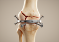Plate-nail fixation shows lowest stress in simulated tibial plateau fractures