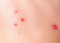 Itchy Skin, Low Blood Counts: Study Probes Anemia Risk in Children With Eczema