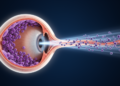 Rare eye lymphoma case shows limits of local therapy in NK/T-cell disease