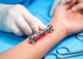 First-in-human wrist implant with two rotation centers shows early stability in five patients